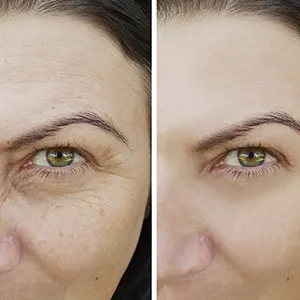 Blepharoplasty (Eyelid Surgery)